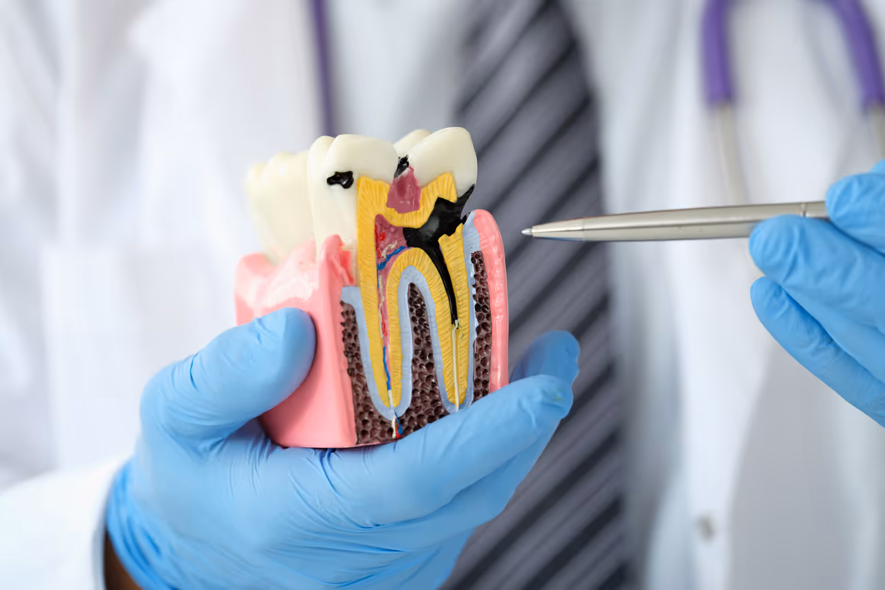How to Prevent Cavities