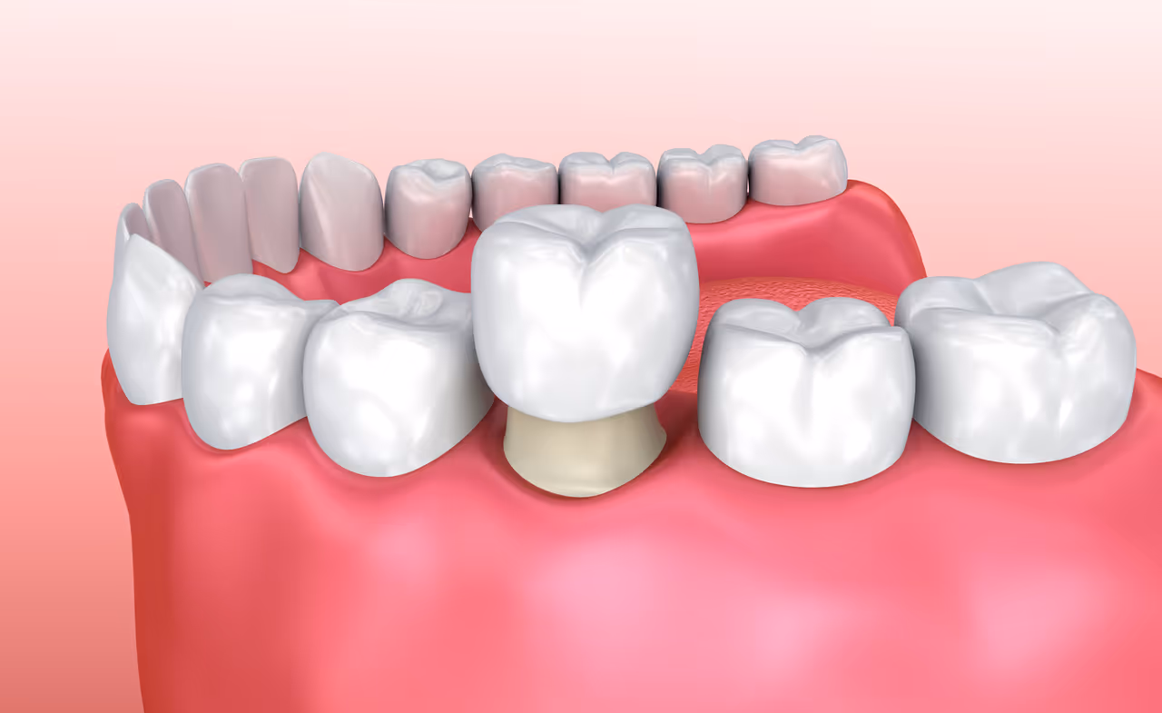 Smile Protection: The Power of Dental Crowns for Lasting Health