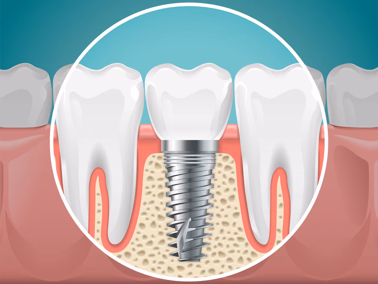 What Is a Dental Implant Abutment and Why Is It Important?